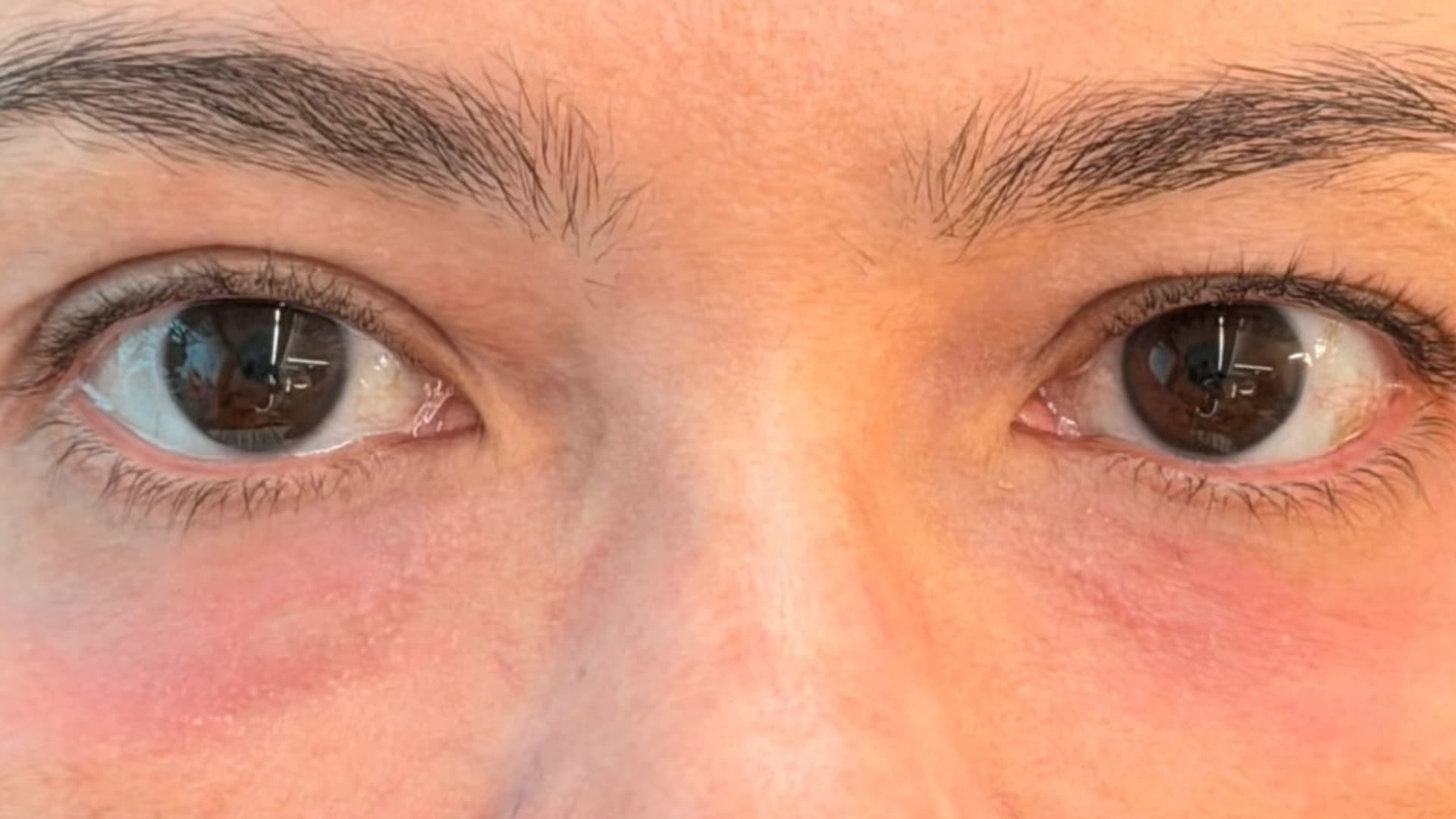 Depois — região periorbital revitalizada, fotografia clínica NanoSkinBio