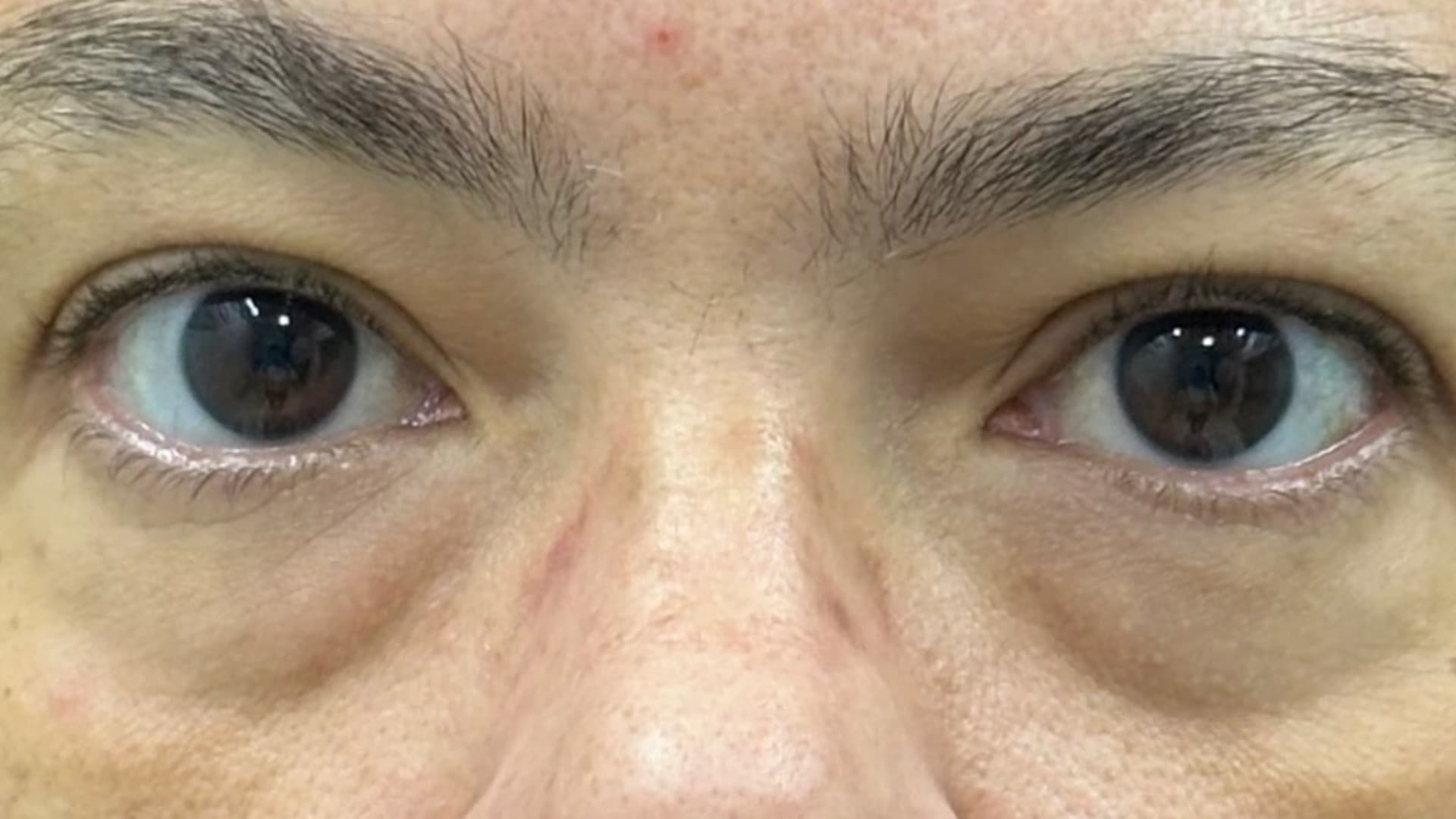 Antes — região periorbital, fotografia clínica NanoSkinBio