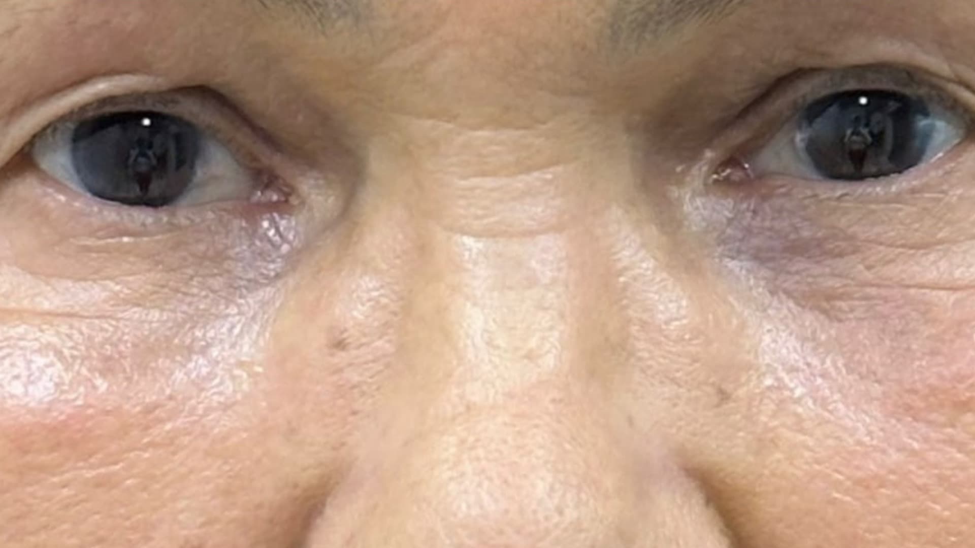 Depois — região periorbital revitalizada, fotografia clínica NanoSkinBio