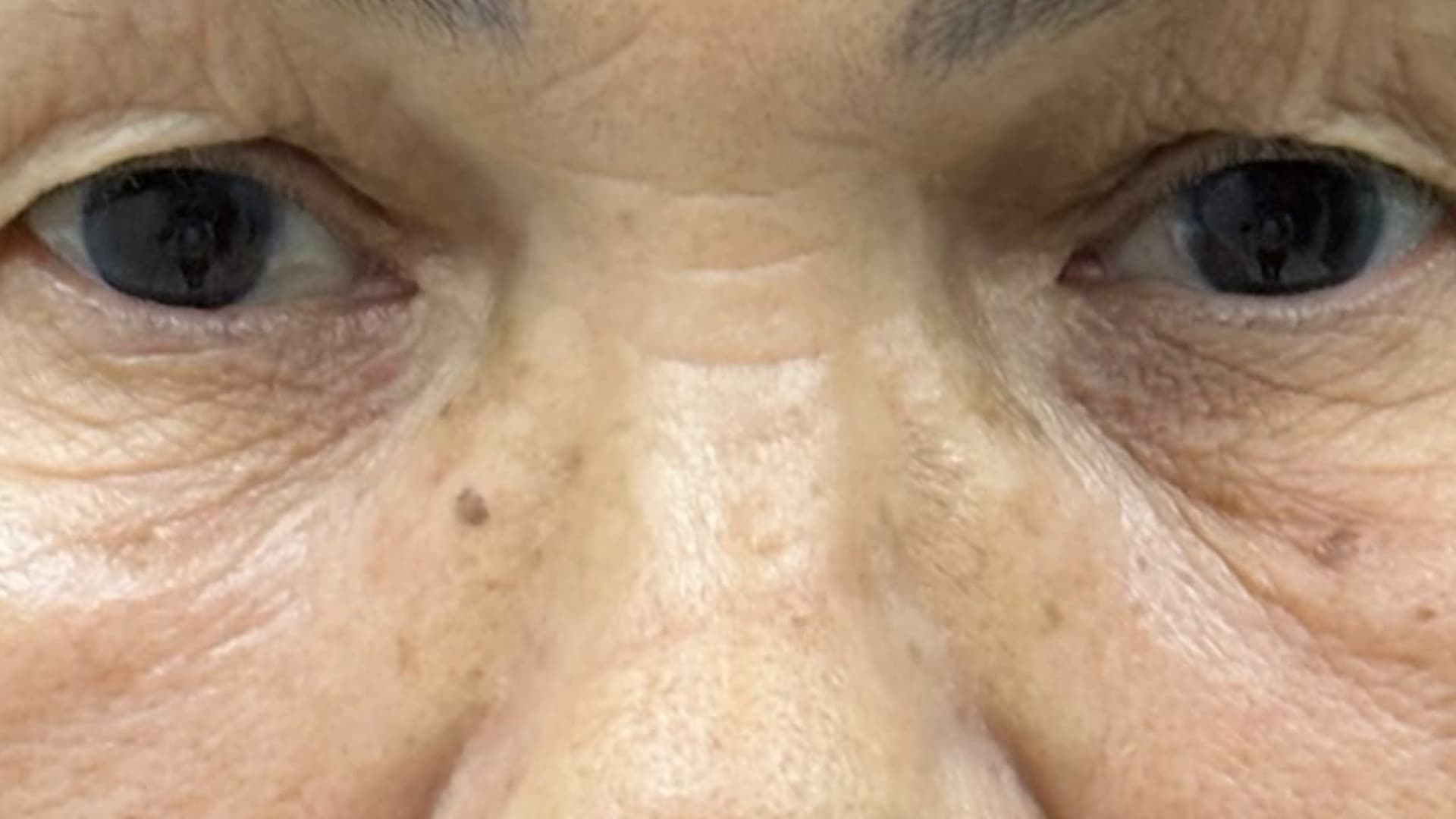 Antes — região periorbital, fotografia clínica NanoSkinBio