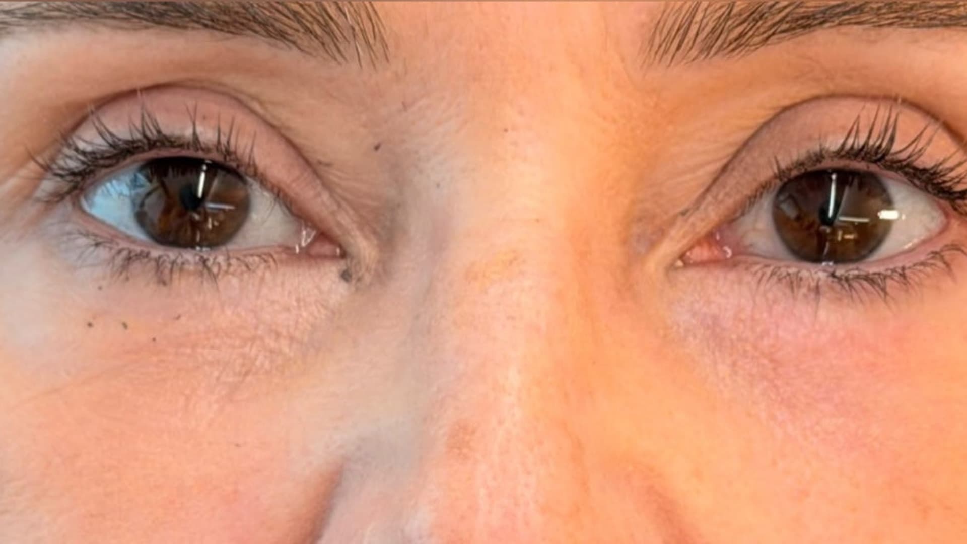 Depois — região periorbital revitalizada, fotografia clínica NanoSkinBio