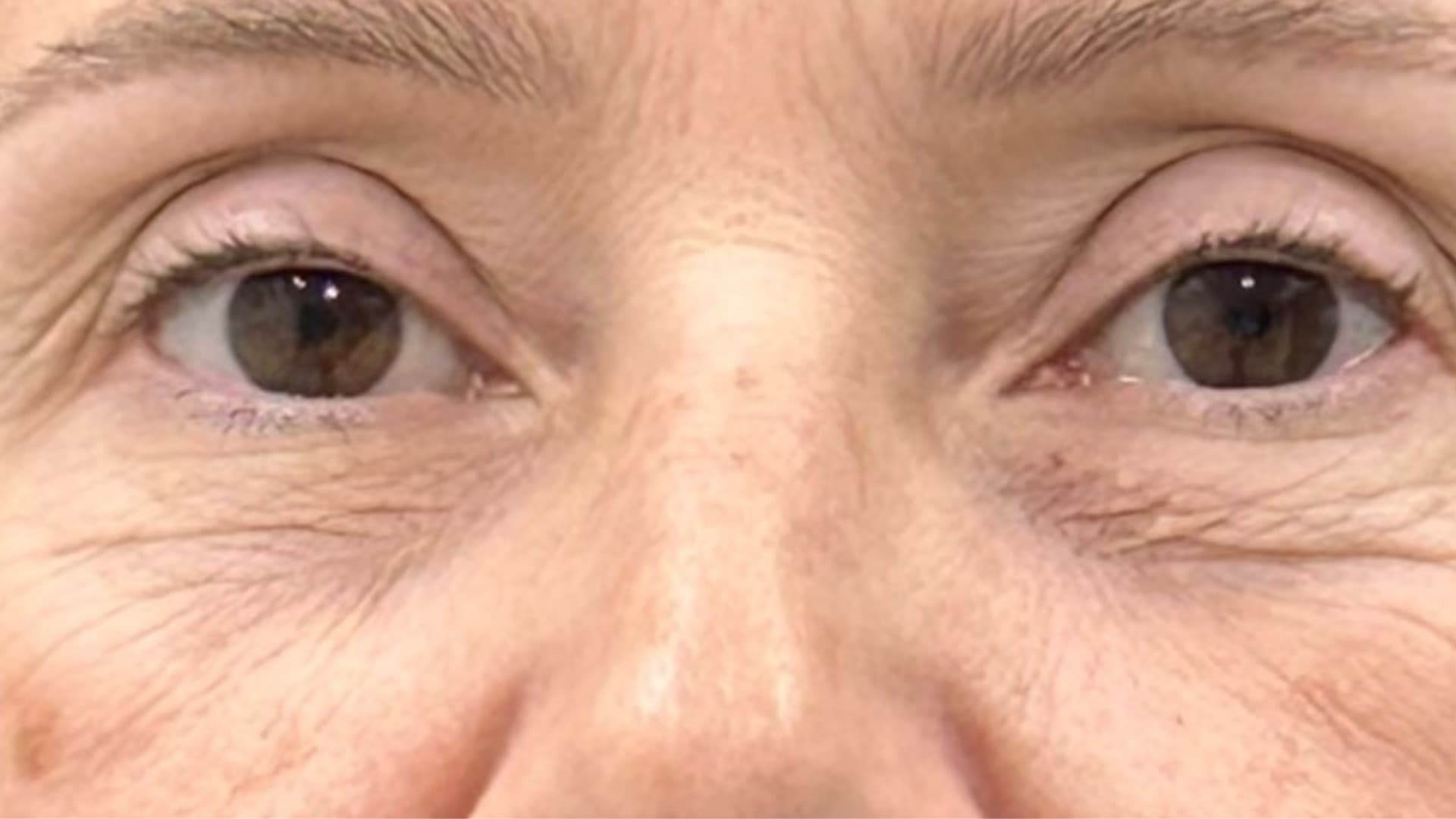Antes — região periorbital, fotografia clínica NanoSkinBio