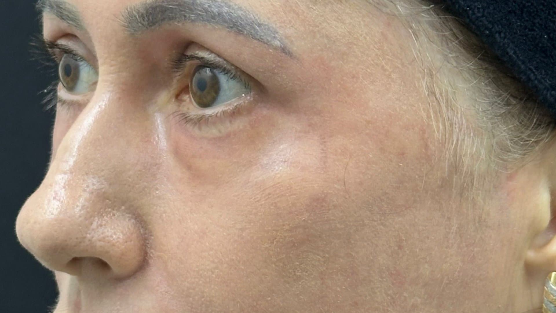 Depois — fotografia clínica NanoSkinBio, resultado do protocolo
