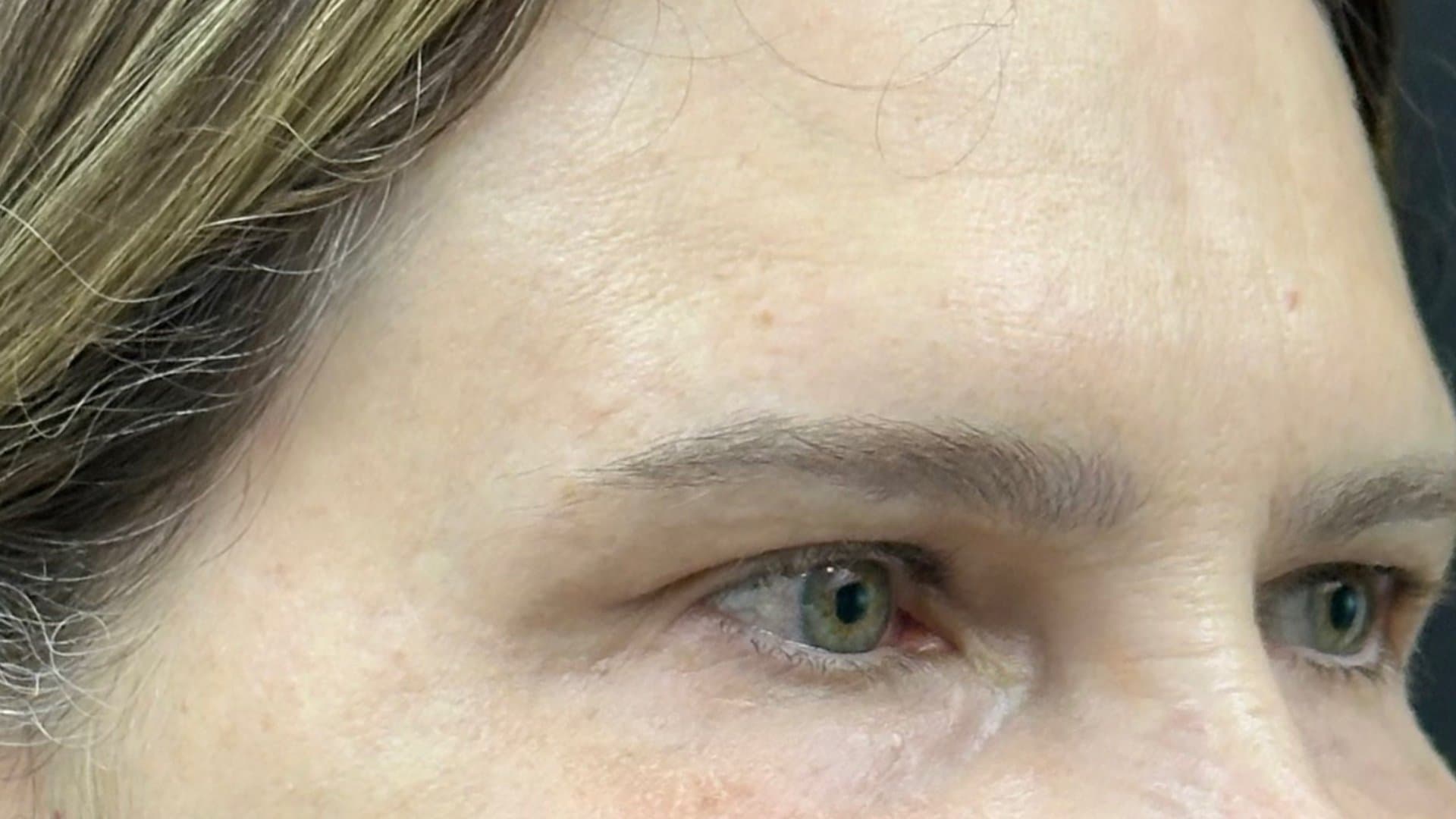 Depois — fotografia clínica NanoSkinBio, resultado do protocolo
