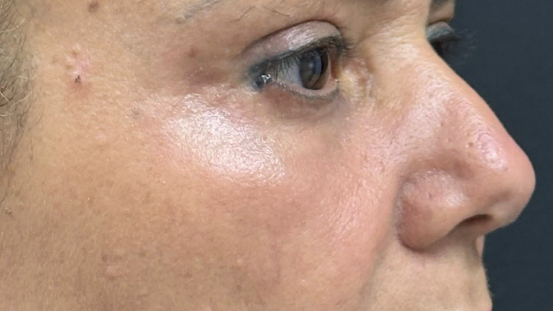 Depois — fotografia clínica NanoSkinBio, resultado do protocolo