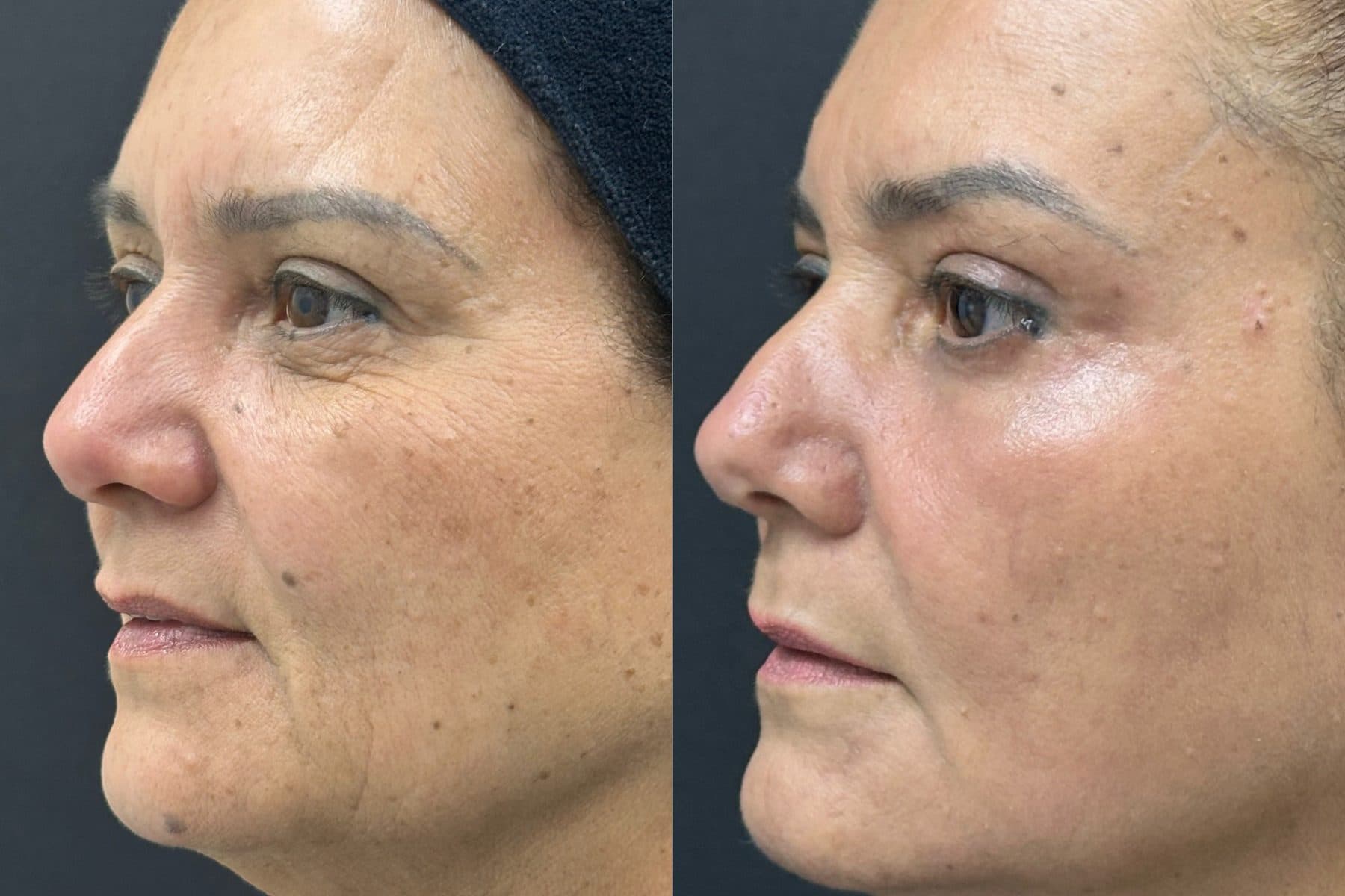 Antes e depois do protocolo NanoSkinBio, perfil facial — fotografia clínica