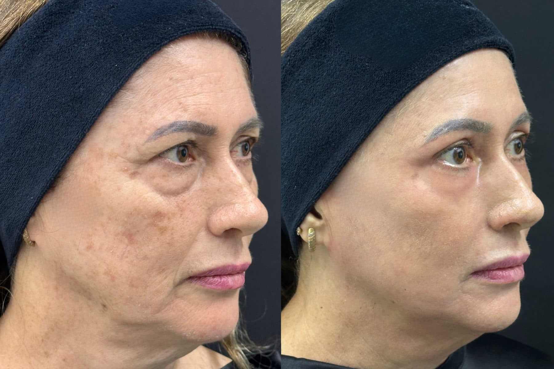 Antes e depois do protocolo NanoSkinBio, perfil facial — fotografia clínica