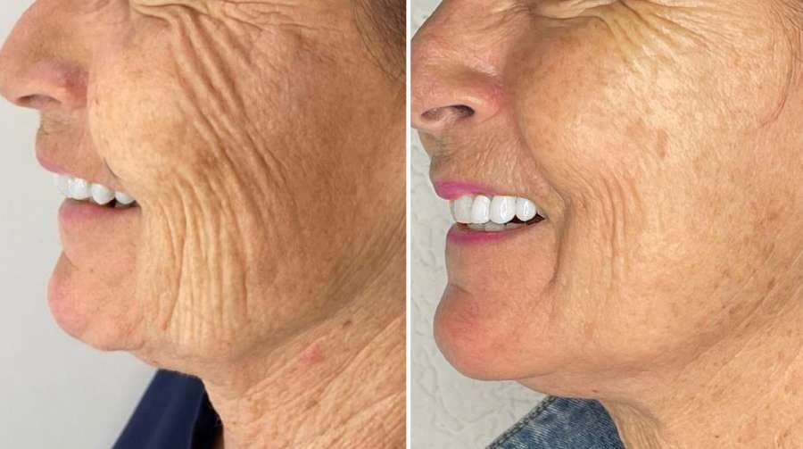 Antes e depois do protocolo NanoSkinBio, região perioral — fotografia clínica